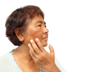 leke ile yaşlı kırsal kadın , akne , yüzünde köstebek ve kırışıklık ( izole arka plan ve sağ tarafta boş alan ) ( anti-aging kavramı )