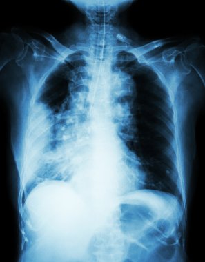 Lung cancer .  Film chest x-ray show right lung mass , wide mediastinum , pneumonia and right pleural effusion clipart