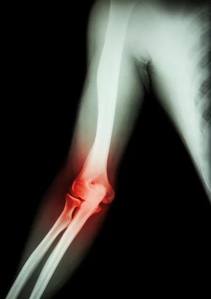 Arthritis am Ellbogen. Film Röntgenbild von Arm, Ellenbogen, Unterarm und Entzündung am Ellenbogen (Gicht, rheumatoide Arthritis) (schwarzer Hintergrund) ) — Stockfoto