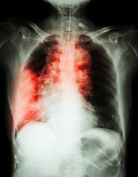 Рак легенів. Рентгенівські знімки грудної клітини показують масу правої легені, широкий медіастатин, пневмонію та правильне плевральне випромінювання — стокове фото