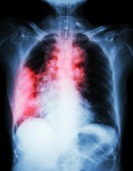 Cáncer pulmonar. La radiografía de tórax muestra masa pulmonar derecha, mediastino ancho, neumonía y derrame pleural derecho — Foto de Stock