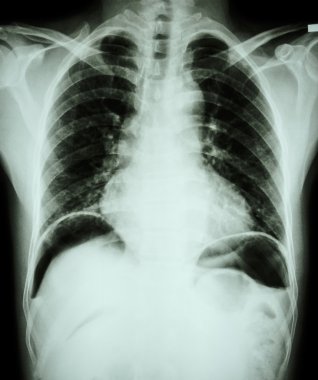 Peptik ülser perforat. ( film göğüs x-ray mide ülseri veya duodenal ülser delikli hava sızıntısı nedeniyle her iki diyafram kubbe altında serbest hava göstermek ) ( cerrahi durum ve konsept )