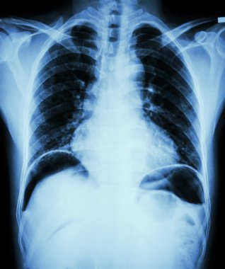 Peptik ülser perforat. ( film göğüs x-ray mide ülseri veya duodenal ülser delikli hava sızıntısı nedeniyle her iki diyafram kubbe altında serbest hava göstermek ) ( cerrahi durum ve konsept )
