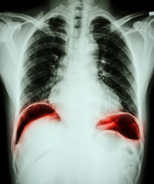 Peptic ulcer perforate . ( film chest x-ray show free air under dome of both diaphragm due to air leak from gastric ulcer or duodenal ulcer perforated ) ( surgical condition and concept ) — Stock Photo, Image