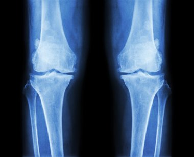 Her iki diz osteoartrit. x-ışını Ap film (ön - arka) diz gösterisi dar ortak alan, osteophyte (teşvik), subcondral skleroz
