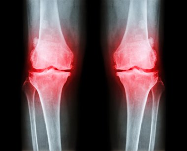 Her iki diz osteoartrit. x-ışını Ap film (ön - arka) diz gösterisi dar ortak alan, osteophyte (teşvik), subcondral skleroz