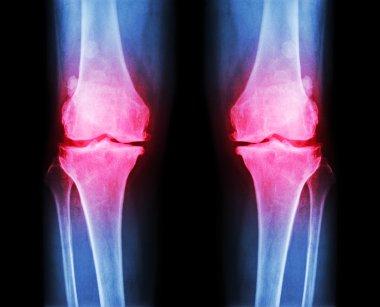 Her iki diz osteoartrit. x-ışını Ap film (ön - arka) diz gösterisi dar ortak alan, osteophyte (teşvik), subcondral skleroz