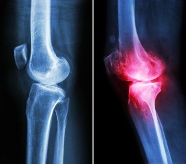 normal diz ( sol görüntü ) ve osteoartrit diz ( sağ görüntü ) ( lateral görünüm )
