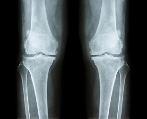 Osteoartritis ambas rodillas. la radiografía de la película AP (anterior-posterior) de la rodilla muestra espacio articular estrecho, osteófita (espolón), esclerosis subcondral — Foto de Stock