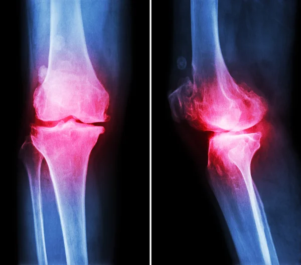 Arthrose Knie. Film-Röntgen-Knie (vordere - hintere und seitliche Ansicht) zeigen engen Gelenkraum, Osteophyten (Sporn), subkondrale Sklerose aufgrund degenerativer Veränderungen — Stockfoto