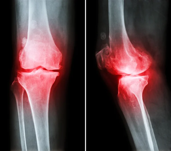 Arthrose Knie. Film-Röntgen-Knie (vordere - hintere und seitliche Ansicht) zeigen engen Gelenkraum, Osteophyten (Sporn), subkondrale Sklerose aufgrund degenerativer Veränderungen — Stockfoto