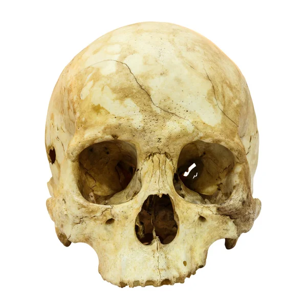 Human Skull Fracture (Mongoloid,Asian) on isolated background — Stock Photo, Image