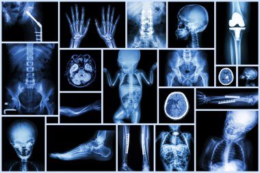 Koleksiyon x-ışını birden fazla yetişkin ve çocuk organ ve ortopedik cerrahi ve birden çok hastalık (inme, osteoartrit diz, kırık kemik, vb)