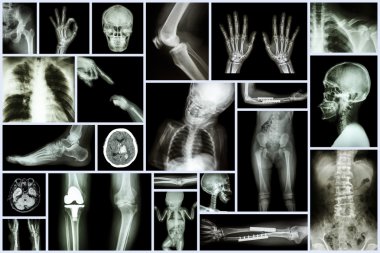 Koleksiyon x-ışını insan ve ortopedik cerrahi çoklu bölüm ve birden çok hastalık (osteoartrit diz, spondiloz, inme, kırık kemik, akciğer tüberkülozu, vb)