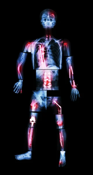 X-Ray hele lichaam en meerdere breuk. Hij werd geëxploiteerd en interne fixatie door plaat & schroef — Stockfoto