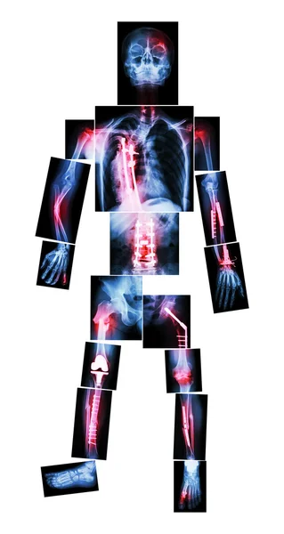 X-Ray hele lichaam en meerdere breuk. Hij werd geëxploiteerd en interne fixatie door plaat & schroef — Stockfoto