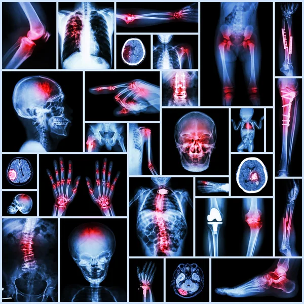 Coleção X-ray parte de humano, operação ortopédica, doença múltipla (fratura, gota, artrite reumatoide, joelho osteoartrite, acidente vascular cerebral, tumor cerebral, escoliose, tuberculose, etc .) — Fotografia de Stock