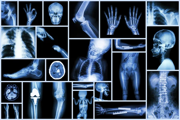 Colección de rayos X parte múltiple de la cirugía humana y ortopédica y enfermedad múltiple (osteoartritis de rodilla, espondilosis, accidente cerebrovascular, fractura ósea, tuberculosis pulmonar, etc. ) — Foto de Stock