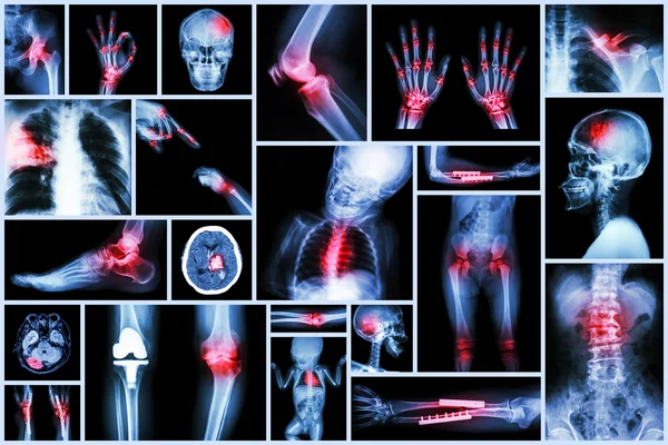 Colección de rayos X múltiples órganos humanos & cirugía ortopédica y enfermedad múltiple (tuberculosis pulmonar, gota, artritis reumatoide, espondilosis, fractura ósea, accidente cerebrovascular, tumor cerebral, etc. ) — Foto de Stock