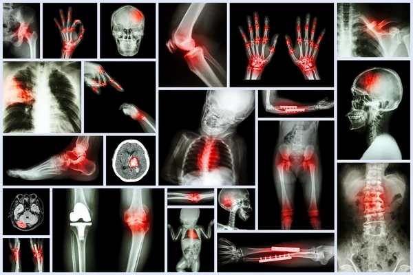 Koleksiyon x-ışını birden fazla insanın organ ve ortopedik cerrahi ve birden çok hastalık (akciğer tüberkülozu, gut, romatoid artrit, spondiloz, kırık kemik, inme, beyin tümörü, vb) — Stok fotoğraf