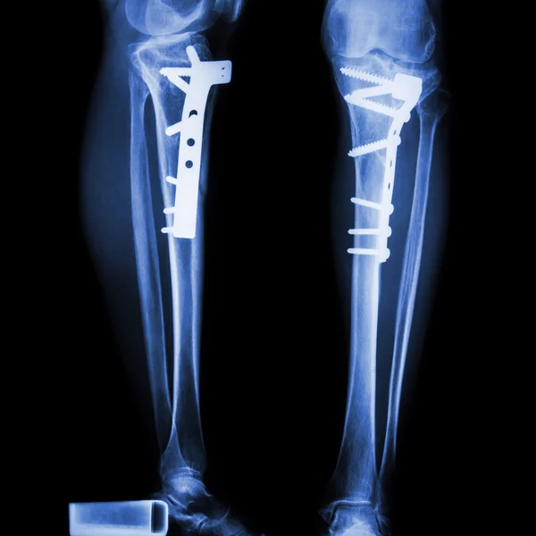 Fractura tibia (hueso de la pierna ) — Foto de Stock
