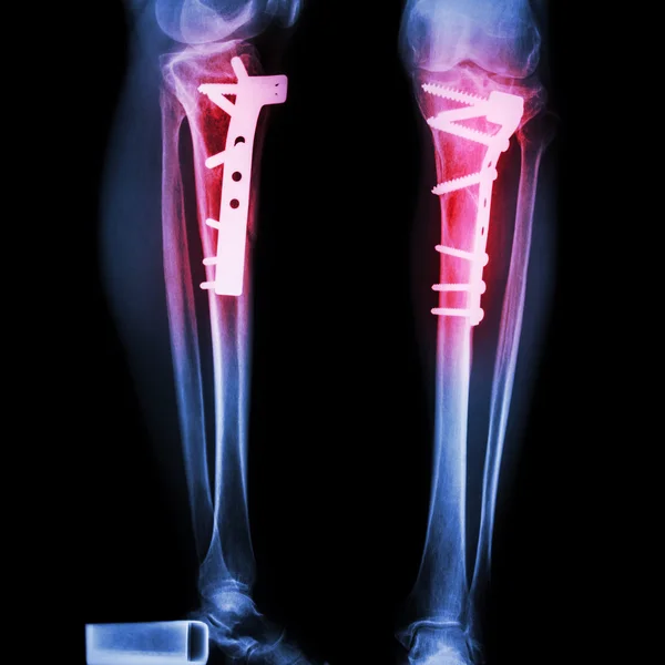 Fracture du tibia (os de la jambe ) — Photo