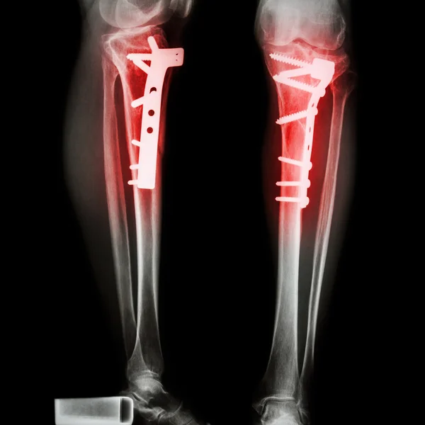 Fracture tibia(leg bone) — Stock Photo, Image