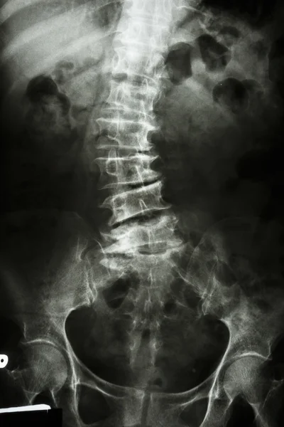 Scoliosis — Stock Photo, Image