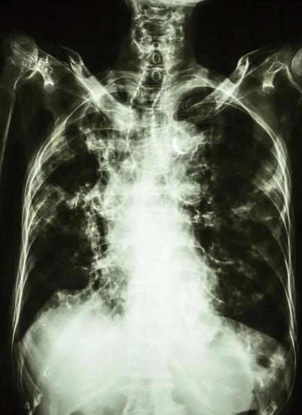 Tuberculosis pulmonar — Foto de Stock