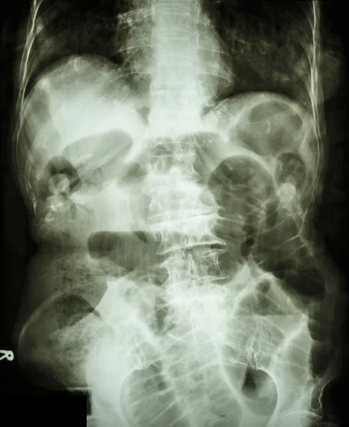 Ostruzione intestinale tenue — Foto Stock