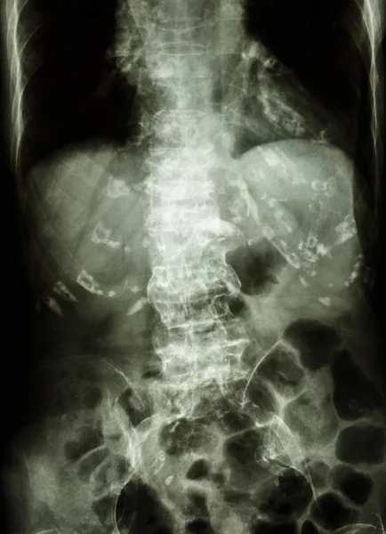 Spondylosis — 스톡 사진