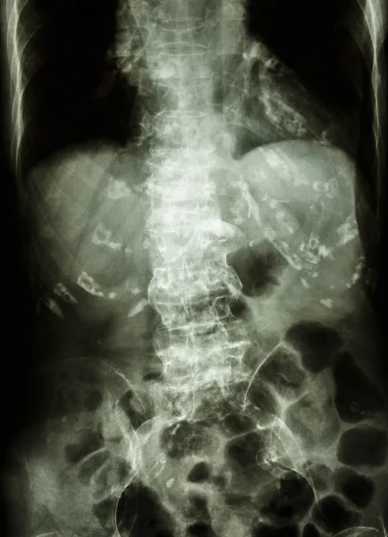 Spondylosis — Stock Fotó