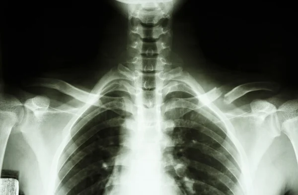 Fracture left clavicle — Stock Photo, Image