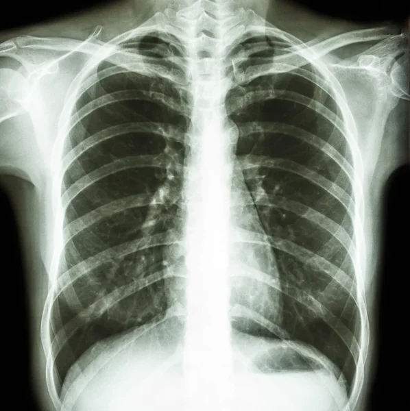 Normal human 's chest — стоковое фото