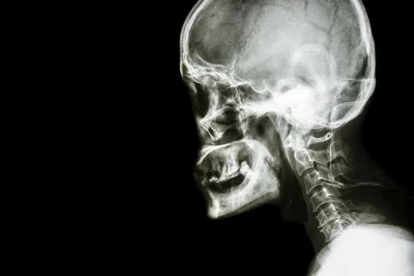 Normale menselijke schedel en cervicale wervelkolom — Stockfoto