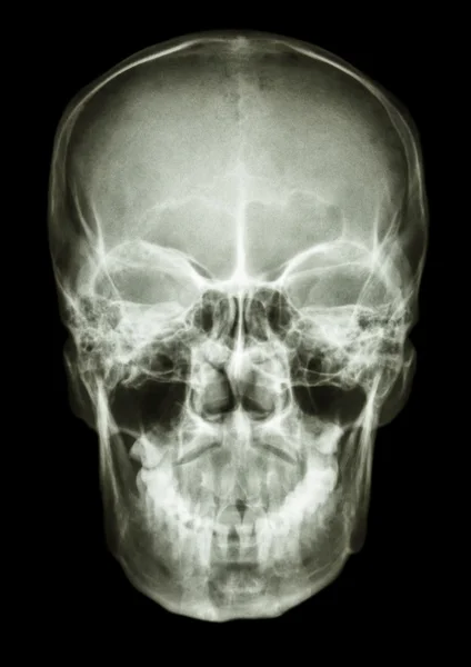 普通の人間の頭蓋骨 — ストック写真