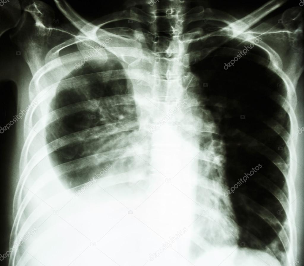 pleural effusion due to lung cancer