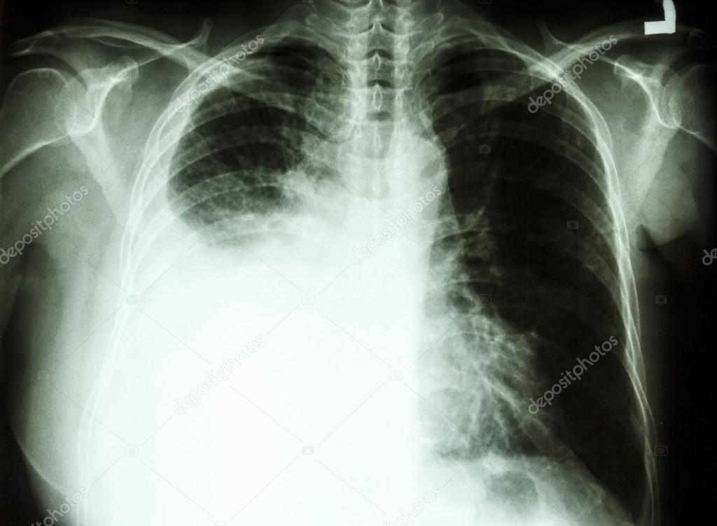 Pleural effusion due to lung cancer  Stock Photo © stockdevil_666