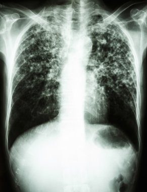 Mycobacterium tüberküloz enfeksiyonu (akciğer tüberkülozu)