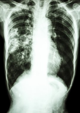 Mycobacterium tüberküloz enfeksiyonu (akciğer tüberkülozu)