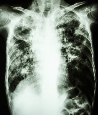 Mycobacterium tüberküloz enfeksiyonu (akciğer tüberkülozu)