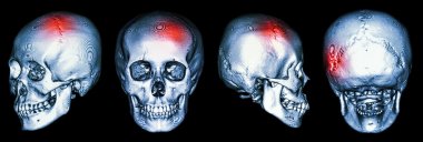 İnsan kafatası ve 3d CT tarama vuruşlu (serebrovasküler)