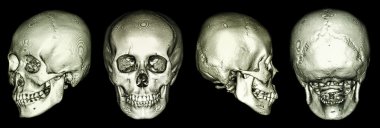 İnsan kafatası ve 3d CT tarama