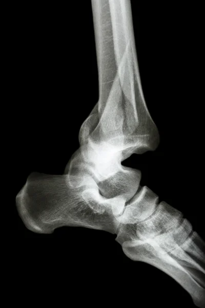 Tibia ve fibula (bacak kemiği) ve ayak bileği çıkığı kırık — Stok fotoğraf