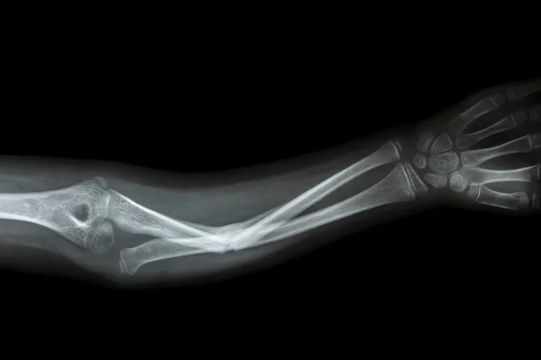척 골의 골절 샤프트 (팔 뚝의 뼈) — 스톡 사진
