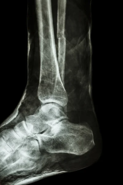 Eixo de fractura da fíbula (osso da perna) com gesso — Fotografia de Stock