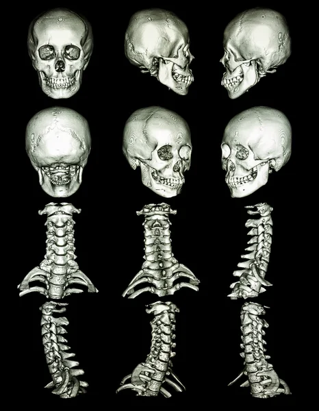 Datortomografi av skallen — Stockfoto