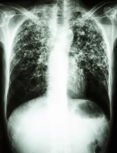 Infecție cu Mycobacterium tuberculosis (Tuberculoză pulmonară ) — Fotografie, imagine de stoc