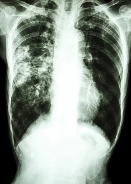 Infecção por Mycobacterium tuberculosis (Tuberculose pulmonar ) — Fotografia de Stock