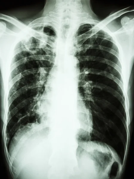 Mycobacterium tuberculosis fertőzés (pulmonalis tuberkulózis) — Stock Fotó